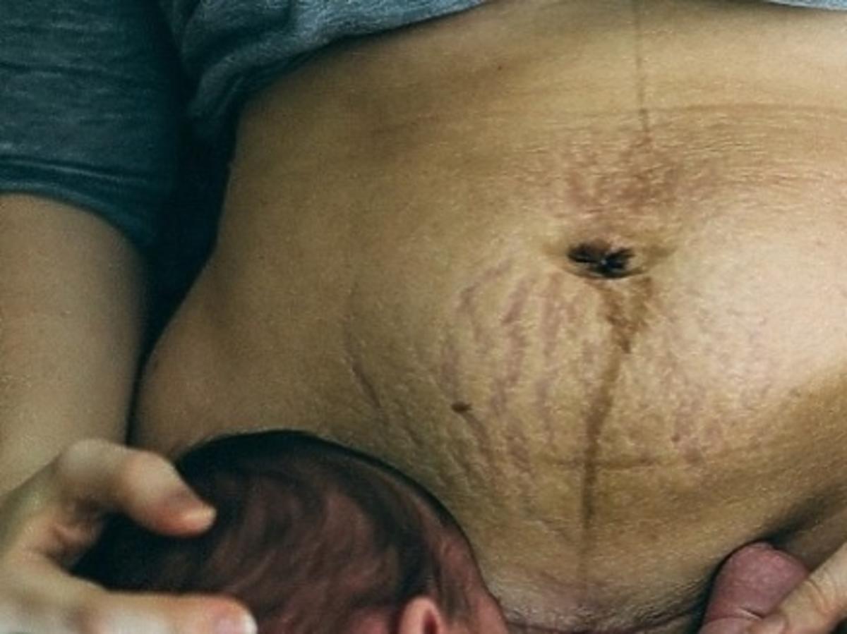 Ciało kobiety po ciąży i porodzie