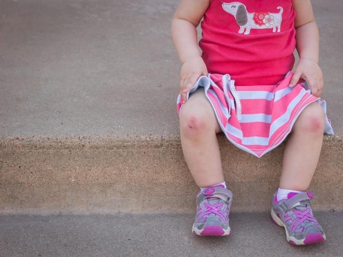 Dziewczynka z potłuczonymi kolanami siedzi na chodniku