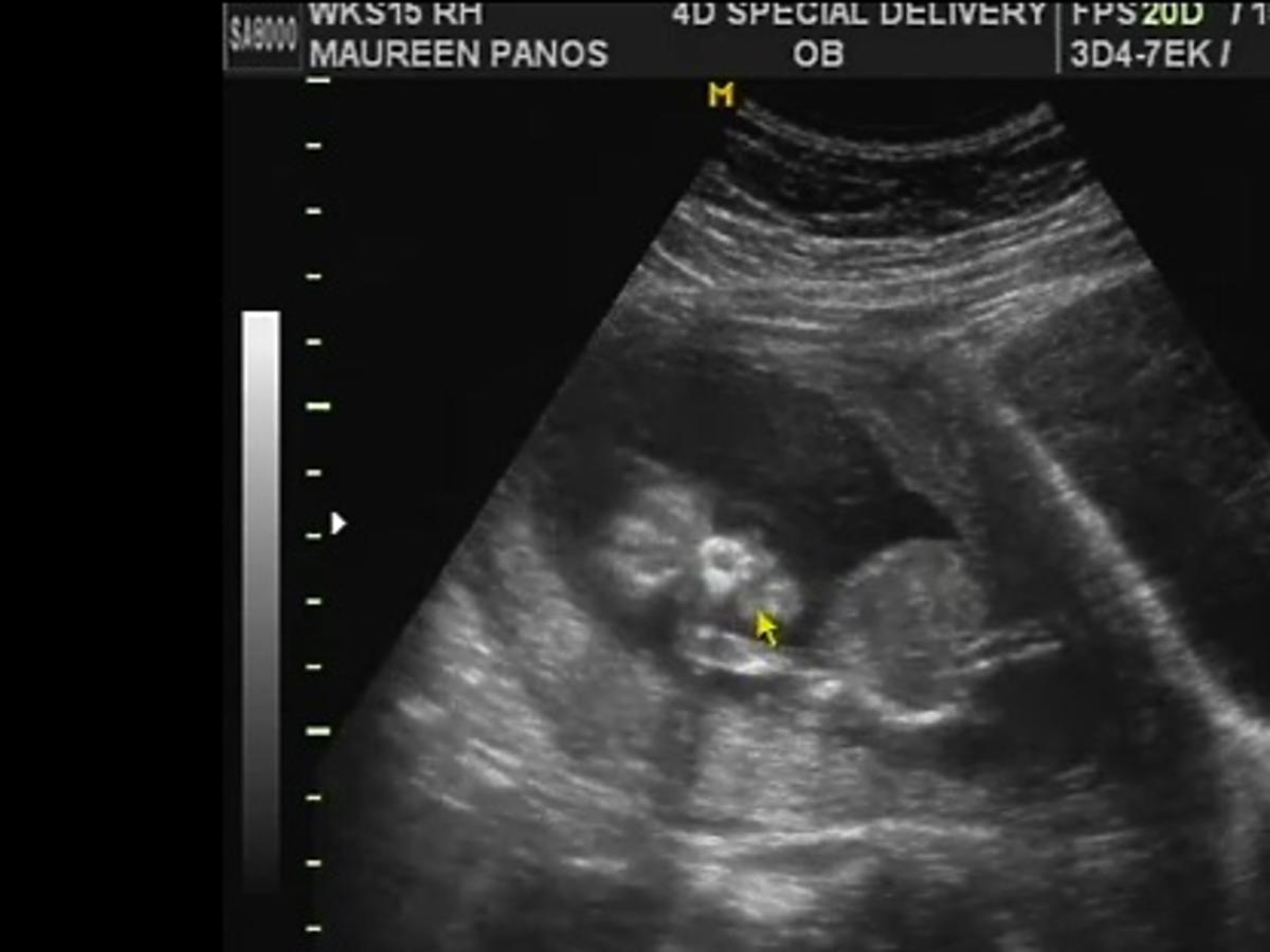 15 tydzień ciąży, usg w ciąży, film z usg w ciąży, rozwój ciąży