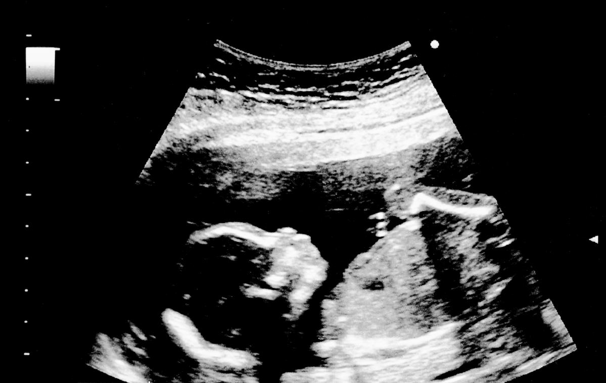 18 tydzień ciąży zdjęcie usg