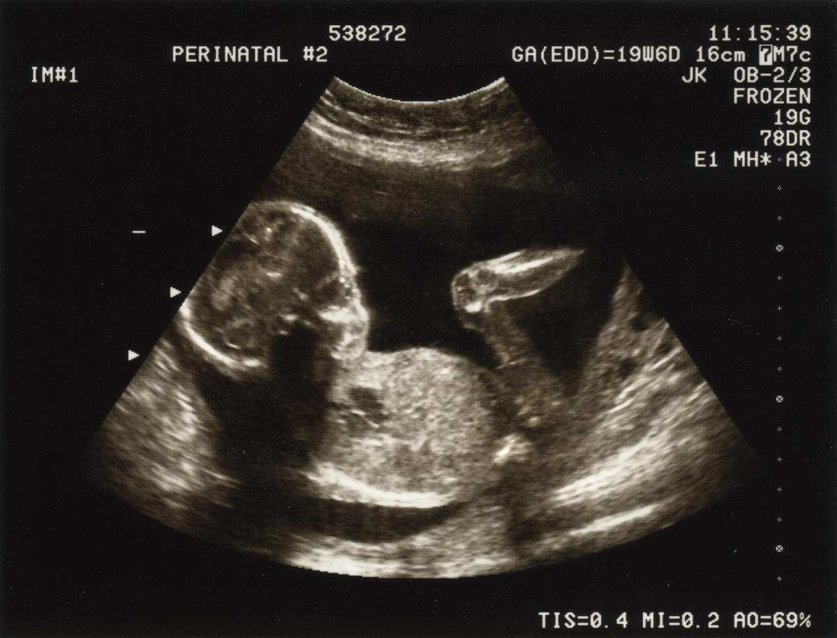 20 tydzień ciąży zdjęcie usg