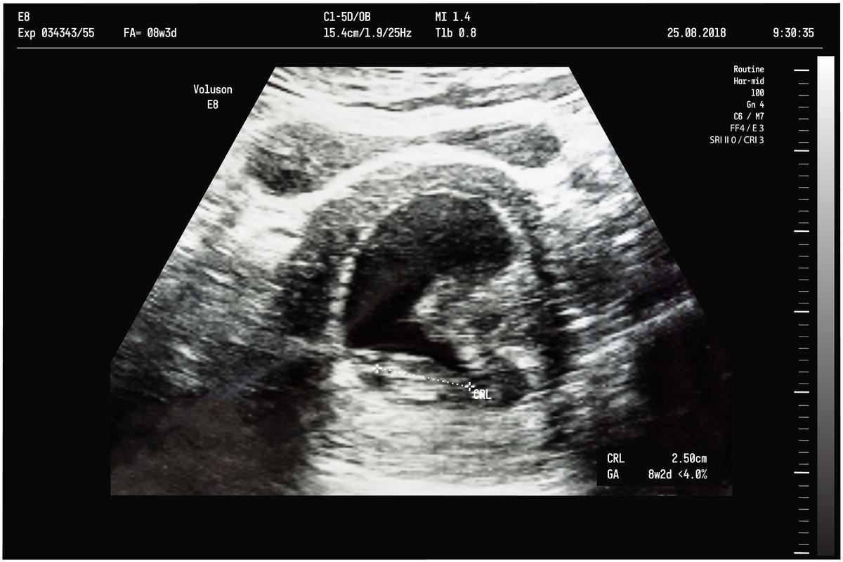 8 tydzień ciąży zdjęcie USG