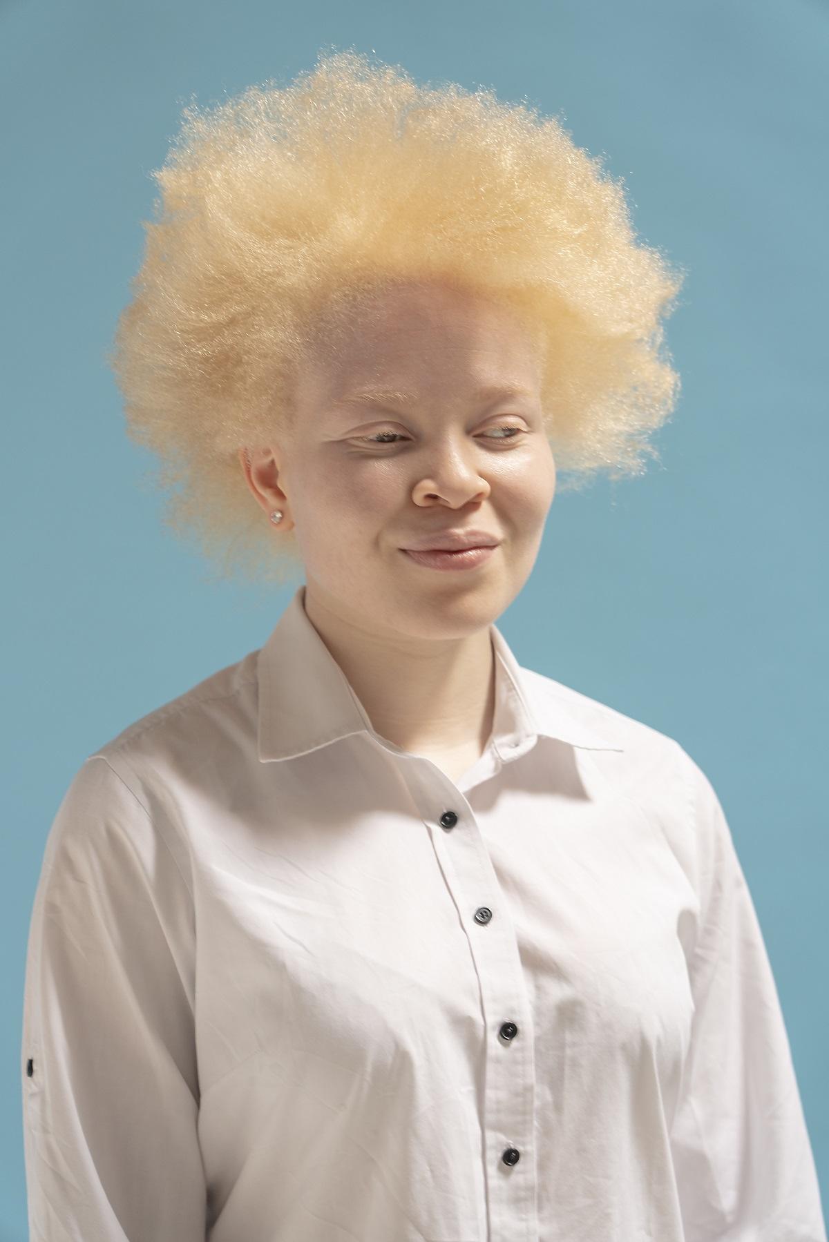 Albinizm Przyczyny Objawy Skutki Czy Bielactwo Wrodzone Mo Na Leczy