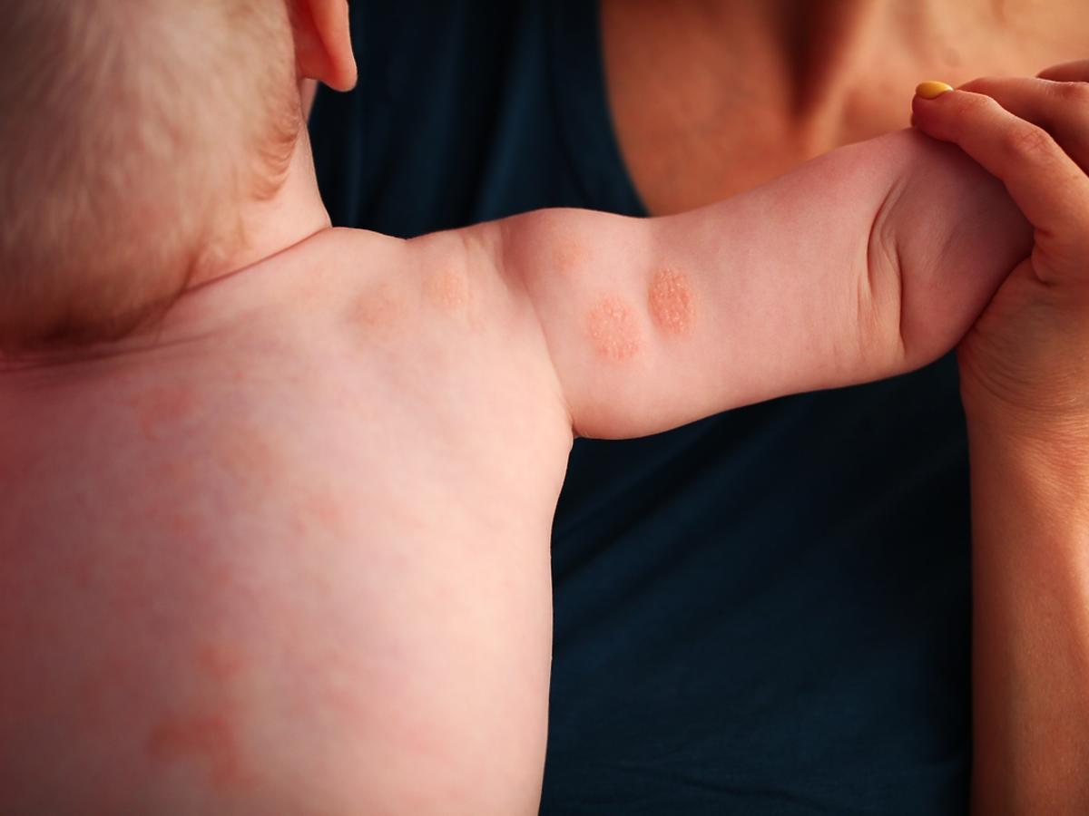 atopowe zapalenie skóry u dzieci