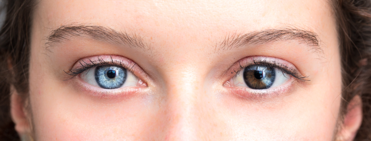 heterochromia iridium
