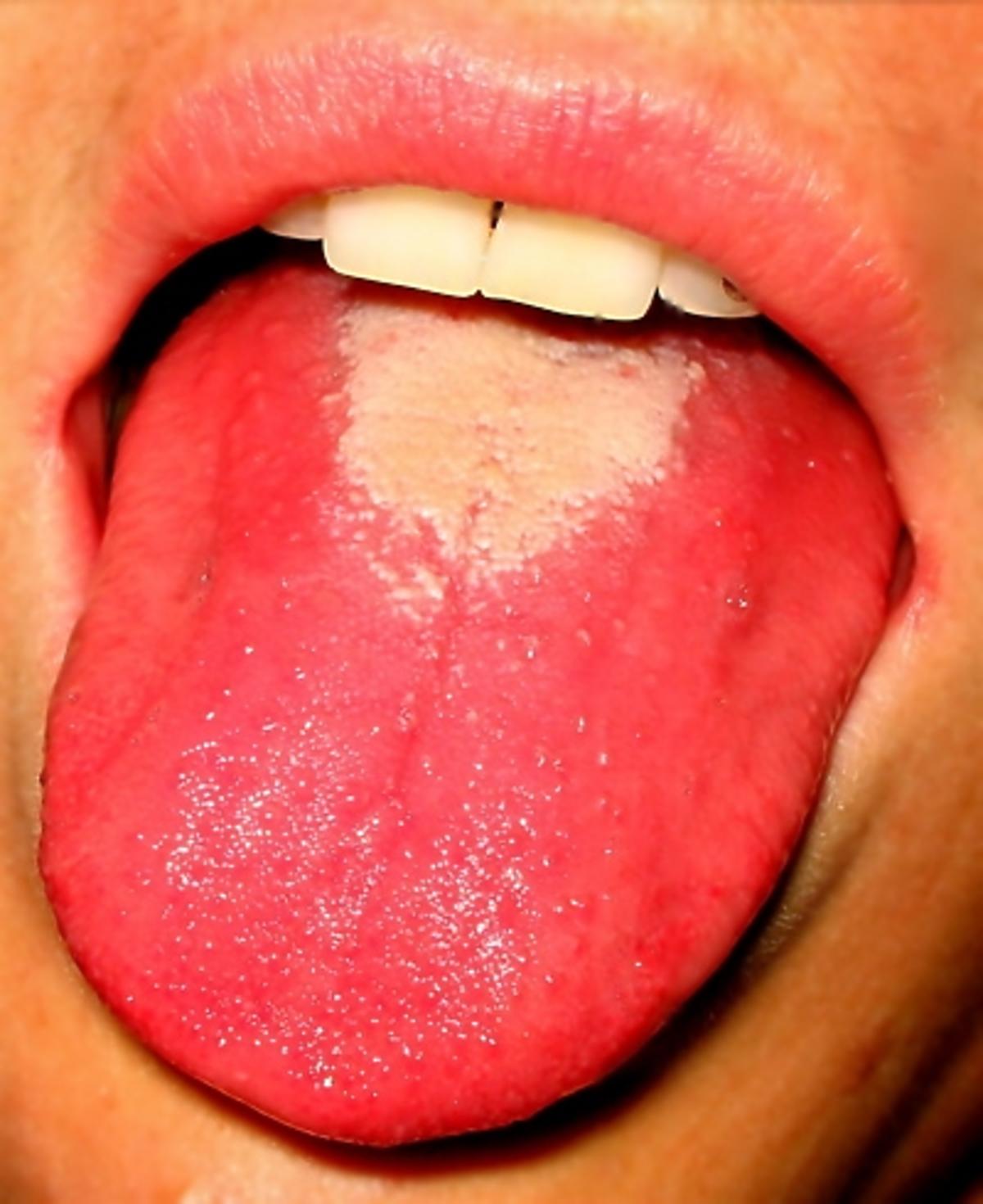 język podczas szkarlatyny