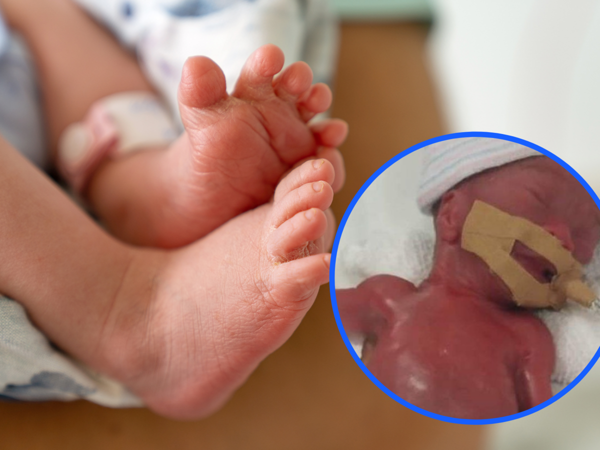 Najmniejszy noworodek na świecie wyszedł ze szpitala. Ważył tyle, co jabłko