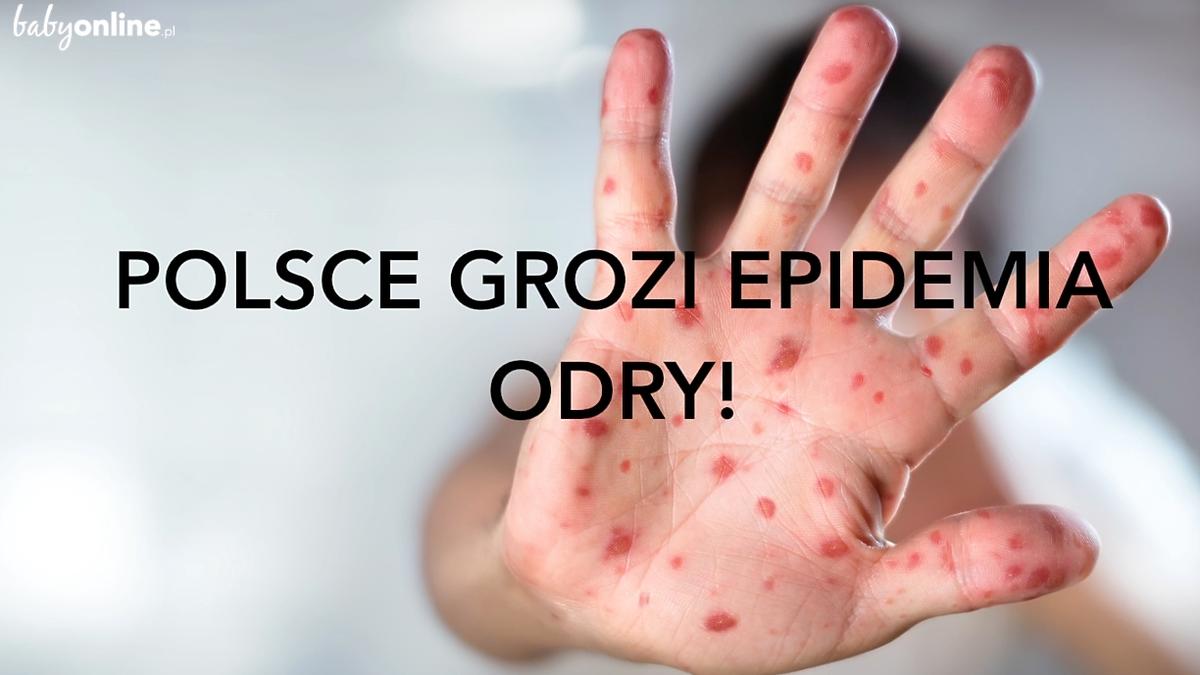 Polsce Grozi Epidemia Odry Dlaczego Należy Bać Się Choroby 9016