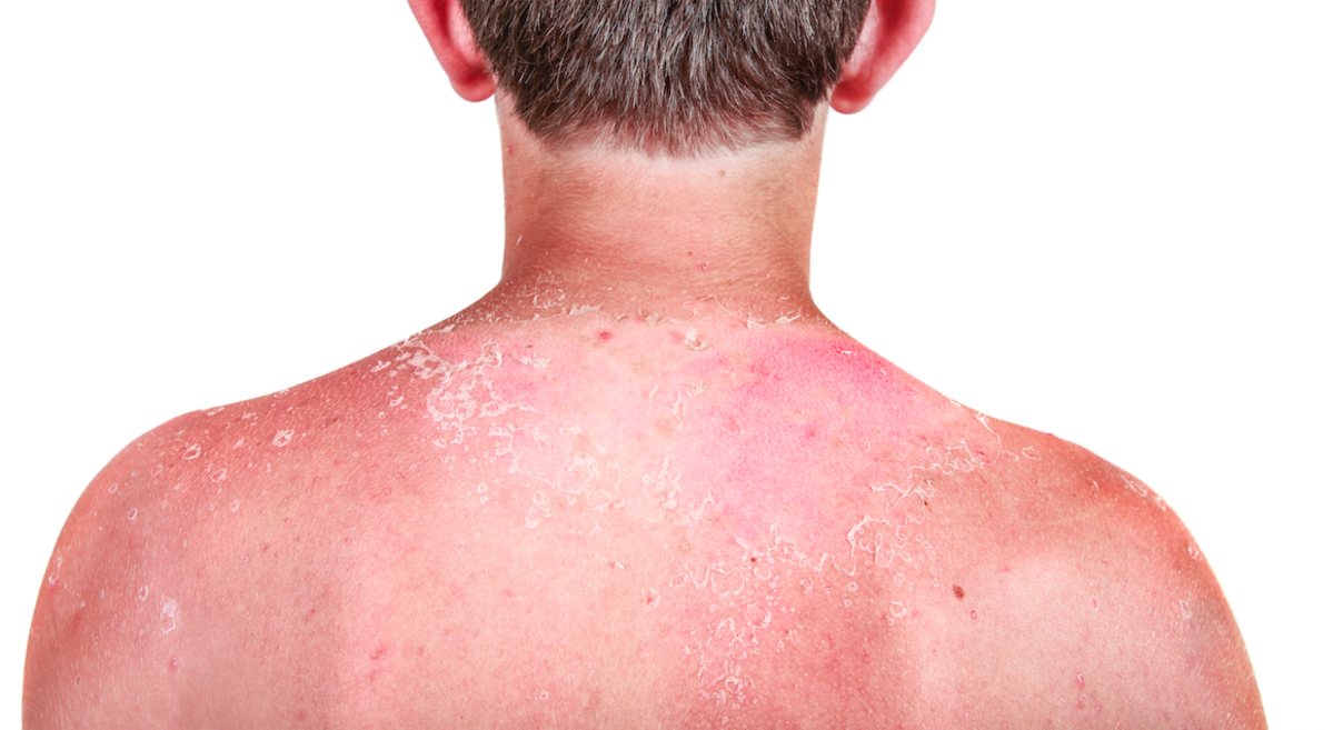 oparzenia słoneczne u dzieci łuszcząca się skóra
