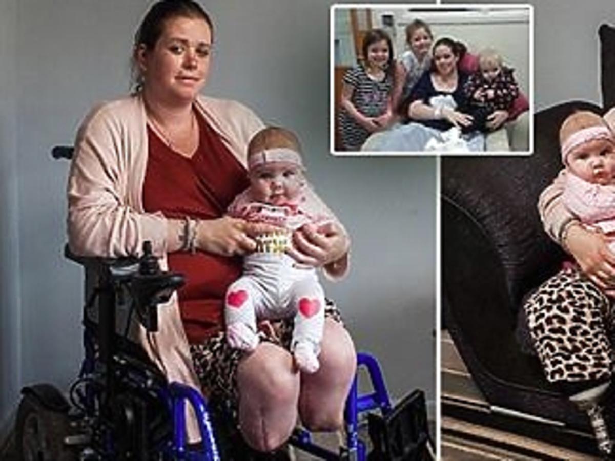 Rodziła, amputowano jej nogi w wyniku komplilacji przy porodzie