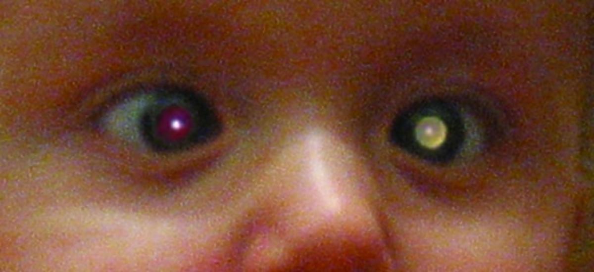 siatkówczak zdjęcie retinoblastoma 
