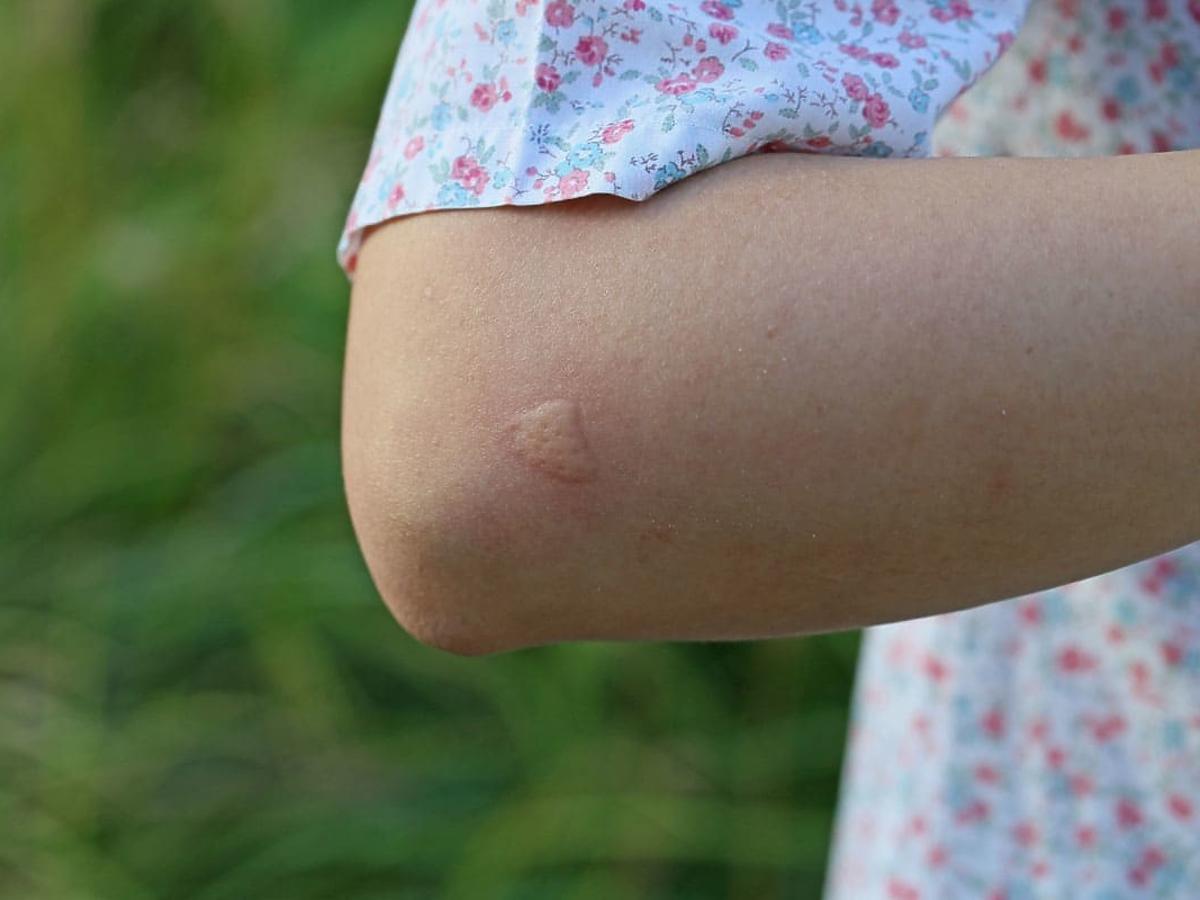 ugryzienie komara u dzieci odczyn po ugryzieniu