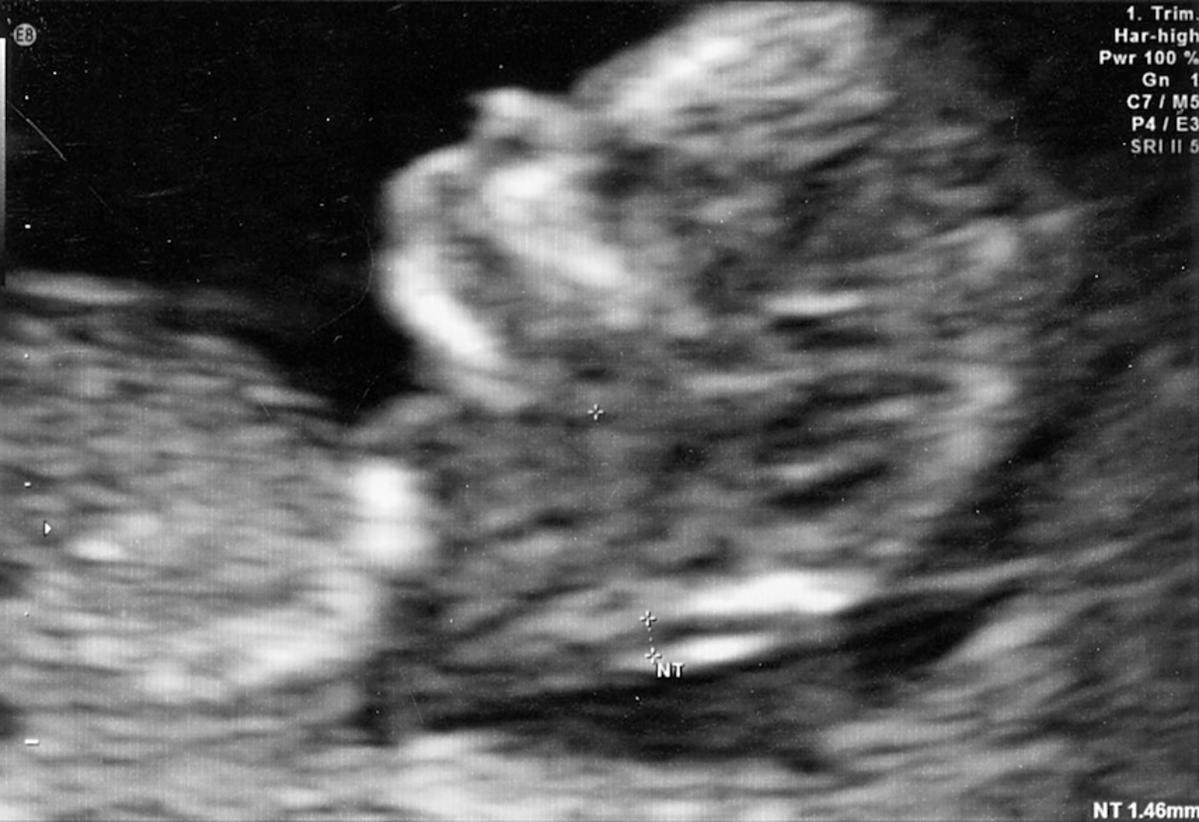 USG 12 tydzień ciąży