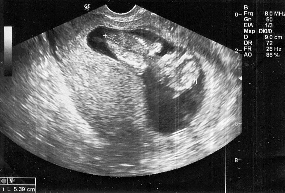 USG 14 tydzień ciąży