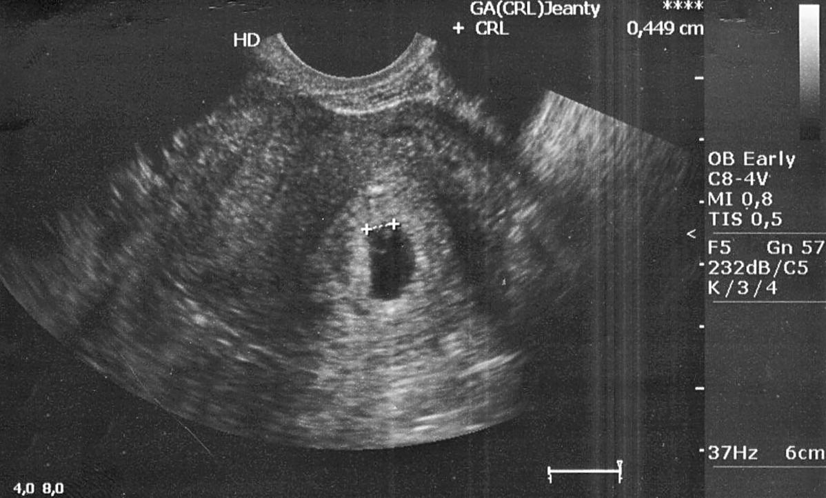 USG 4 tydzień ciąży