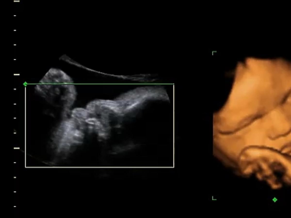 usg w ciąży, 31 tydzień ciąży, usg 3D