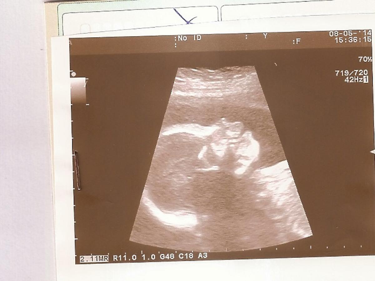 Wydruk z badania USG w czasie ciąży, ciąża