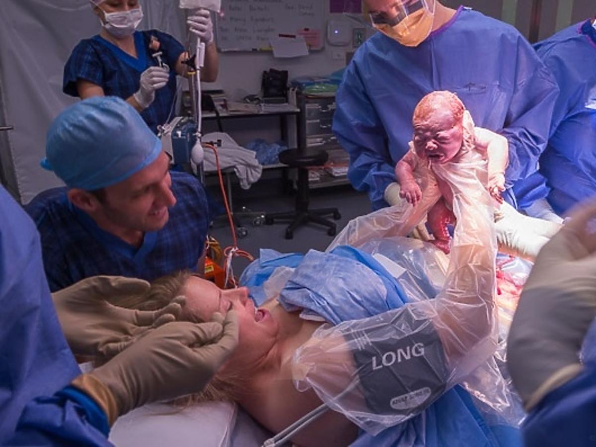 Wyjęcie dziecka z brzucha mamy - cesarskie cięcie