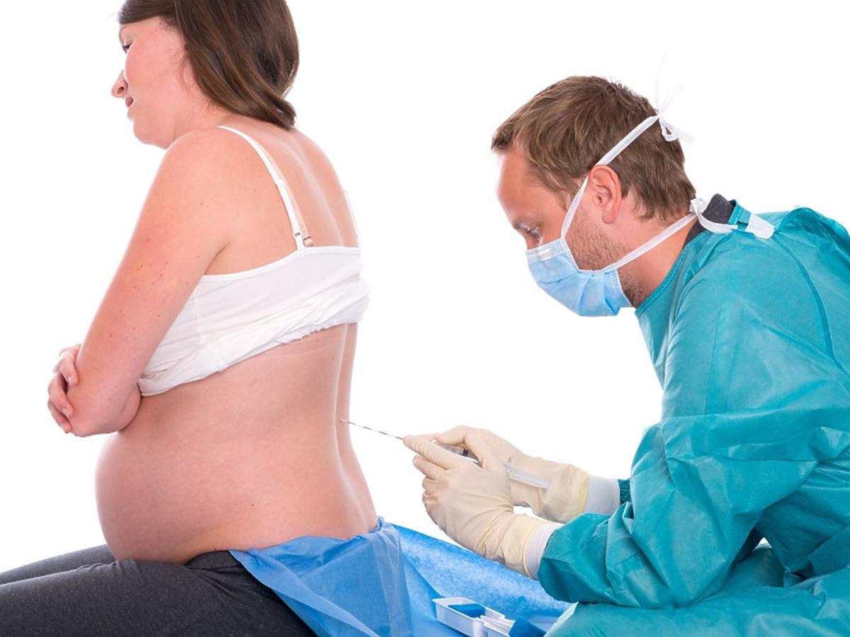 znieczulenie zewnątrzoponowe przy porodzie