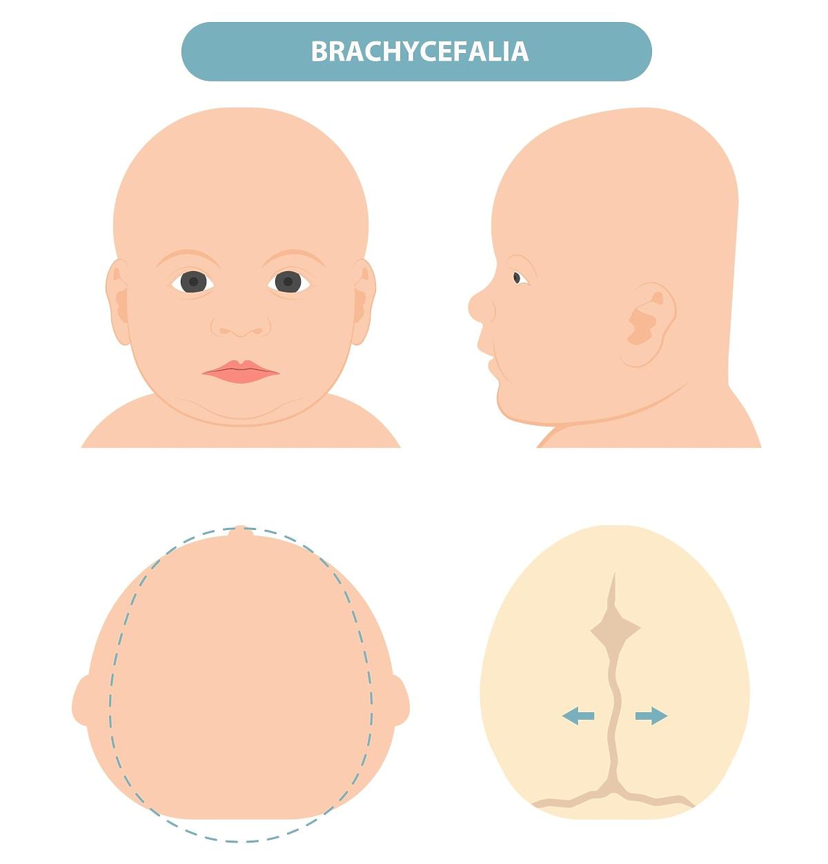 Zniekształcona główka niemowlaka brachycefalia