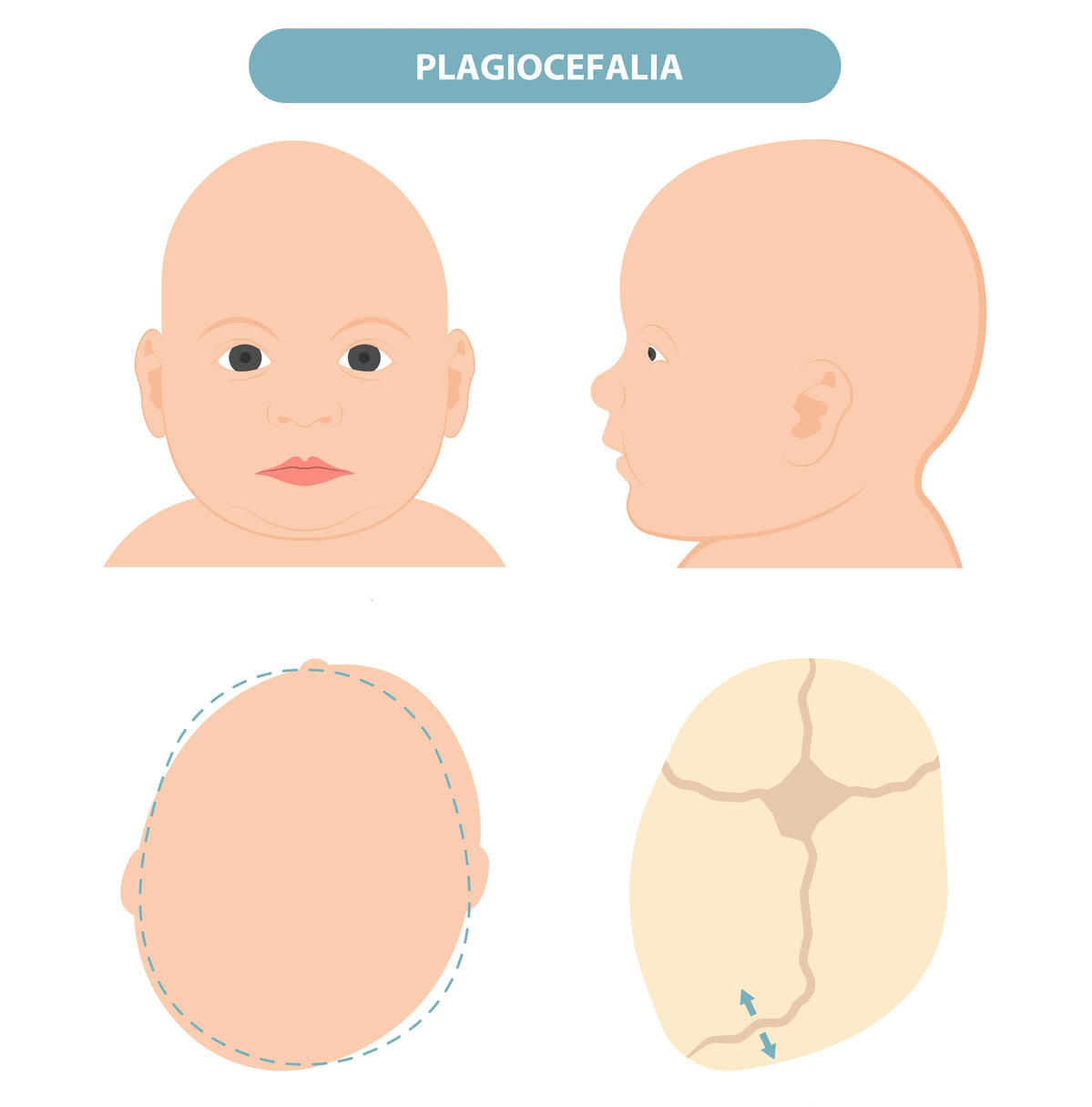 Zniekształcona główka niemowlaka plagiocefalia