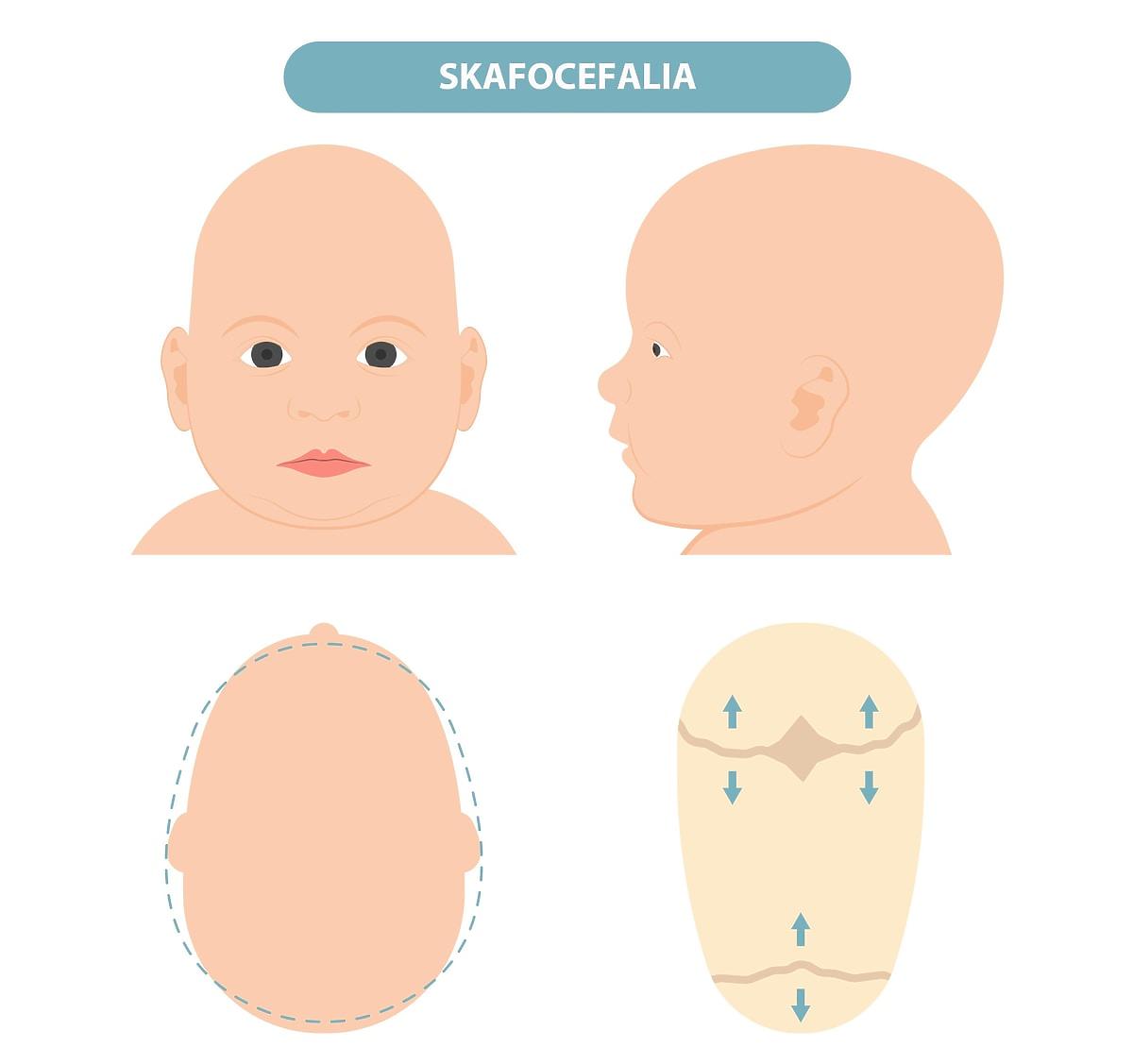 Zniekształcona główka niemowlaka skafocefalia