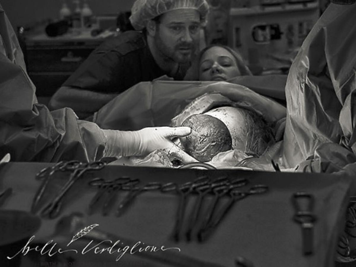 Niezwykła sesja zdjęciowa podczas porodu przez cesarskie cięcie