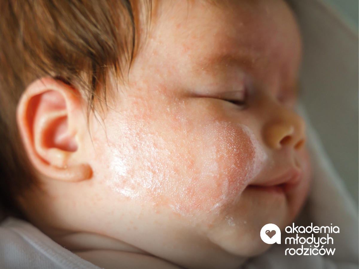 objawy alergii u dziecka