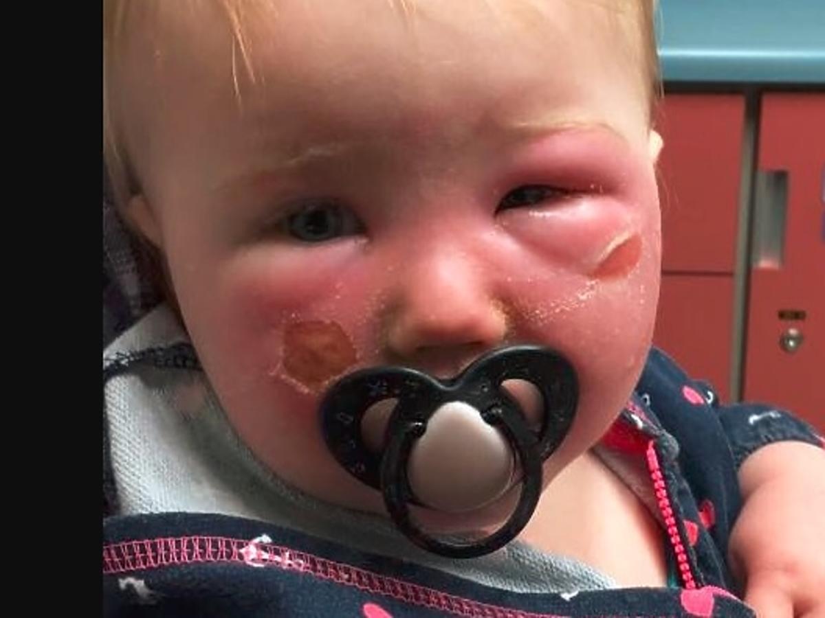 Oparzenie na twarzy dziecka