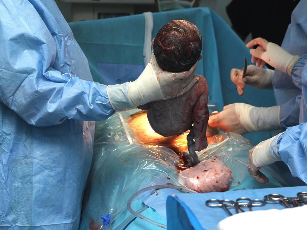 pierwsze dziecko urodzone po przeszczepie macicy