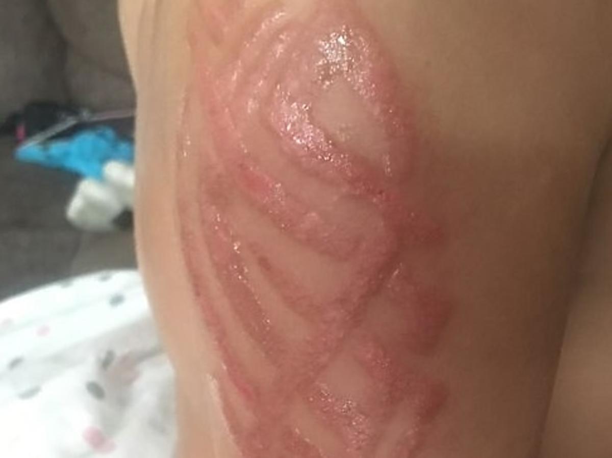 Reakcja alergiczna po tatuażu z henny